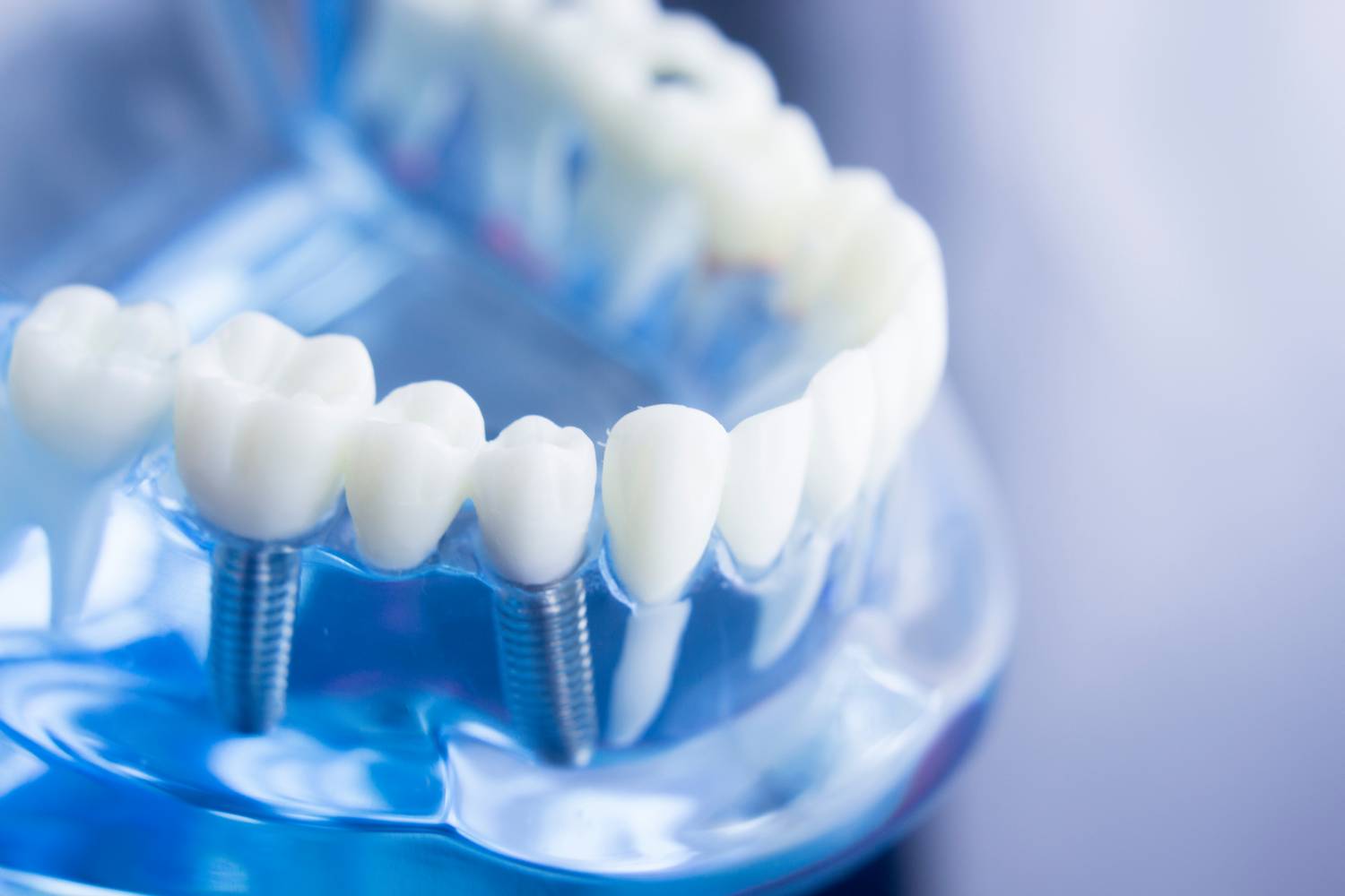 Implanty dentystyczne – powiew przyszłości